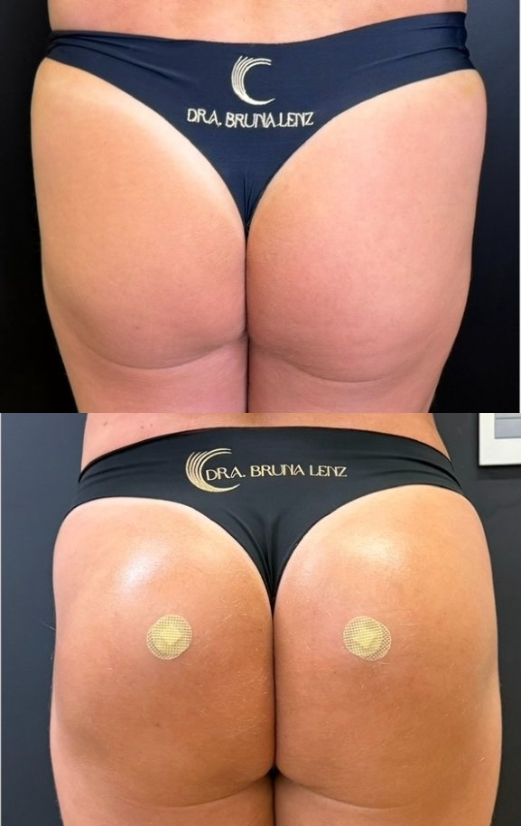Harmonização Glútea na Lenzavi Clinic